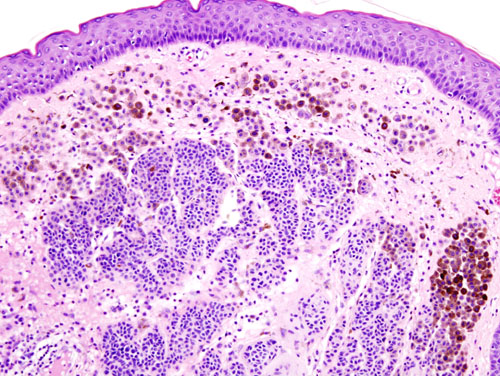 File:Nevocellular nevus histopathology (2).jpg