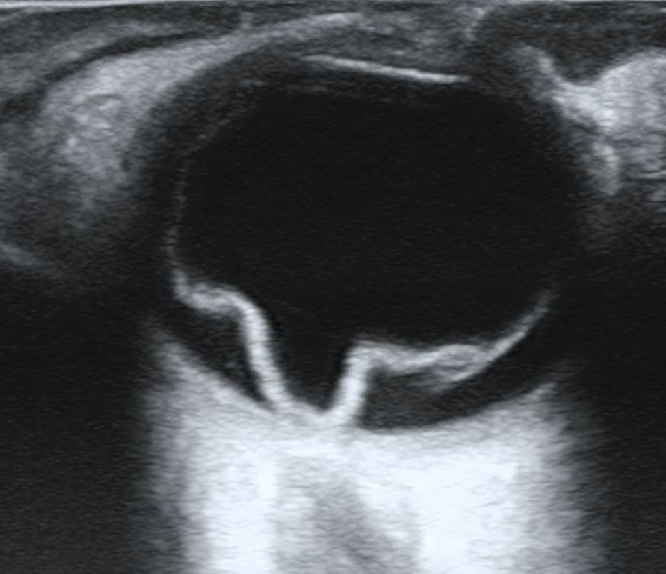 retinal detachment vision