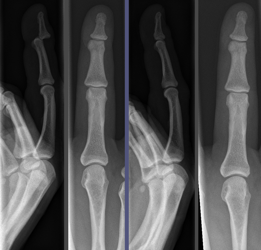 Reduction (orthopedic surgery) - Wikipedia