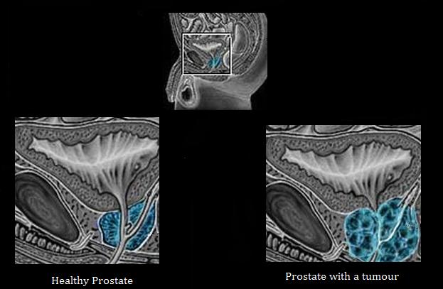 metode ale glandei prostatei