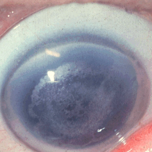 File:Schnyder corneal dystrophy 1.JPEG