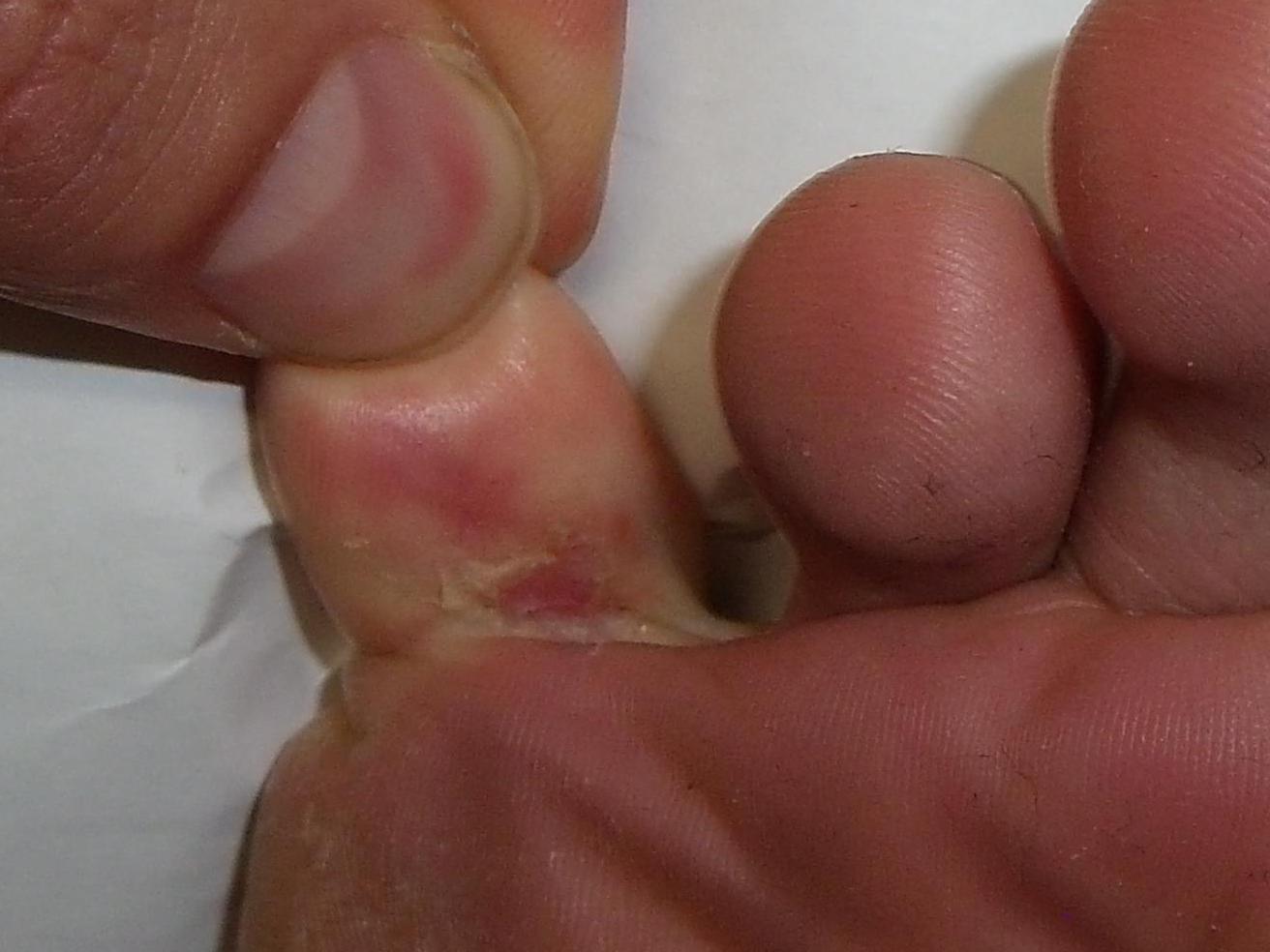 Athlete’s foot (tinea pedis): Pictures, symptoms and treatment