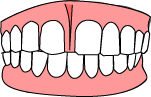 echtes Diastema