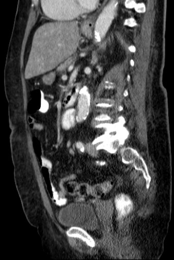 File:Hufeisenniere 06 - CT - sagittal - 027.jpg