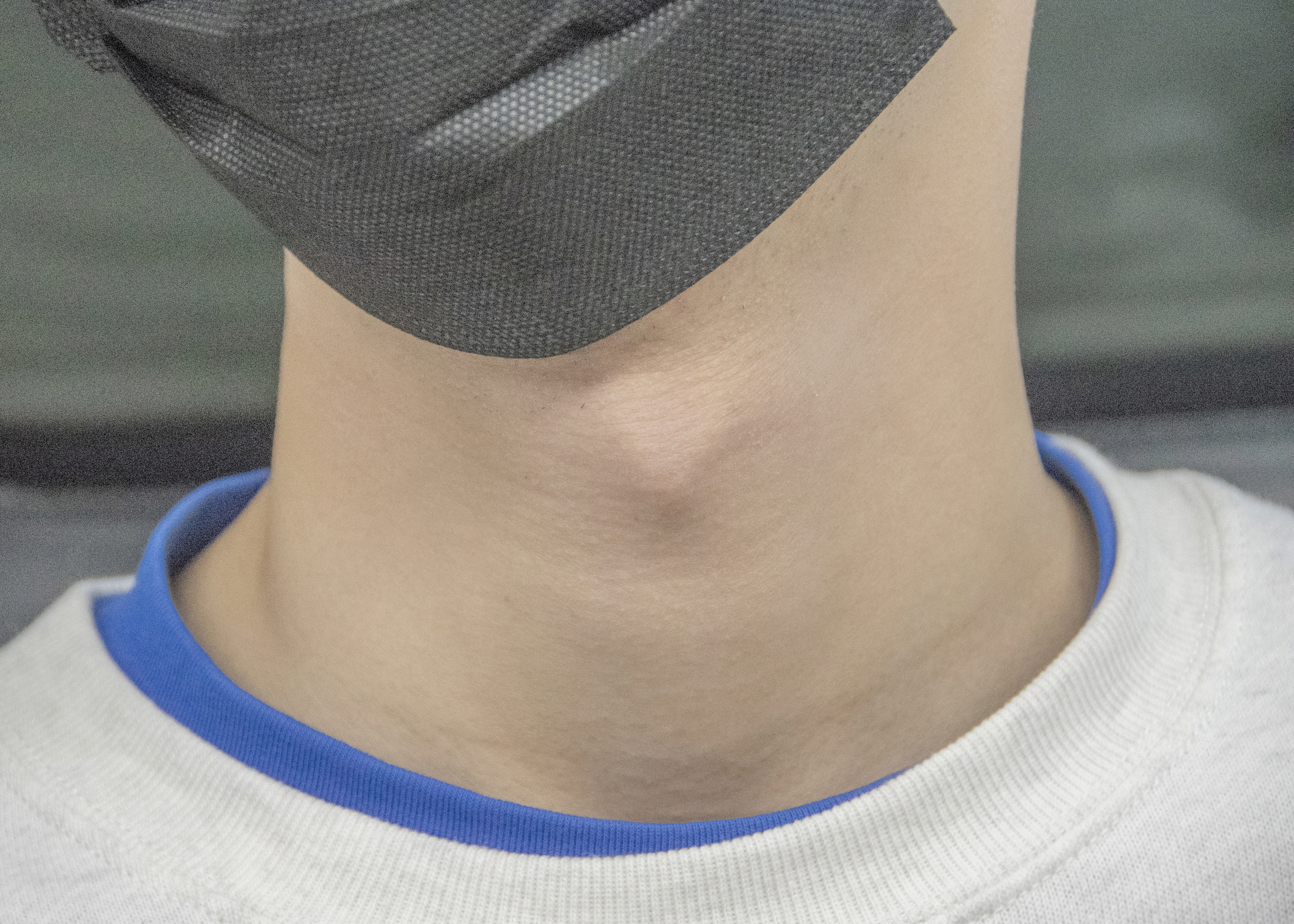 Adam s apple