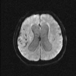 File:NPH MRI 169.png