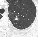 CT of a lung nodule with pleural retraction.png