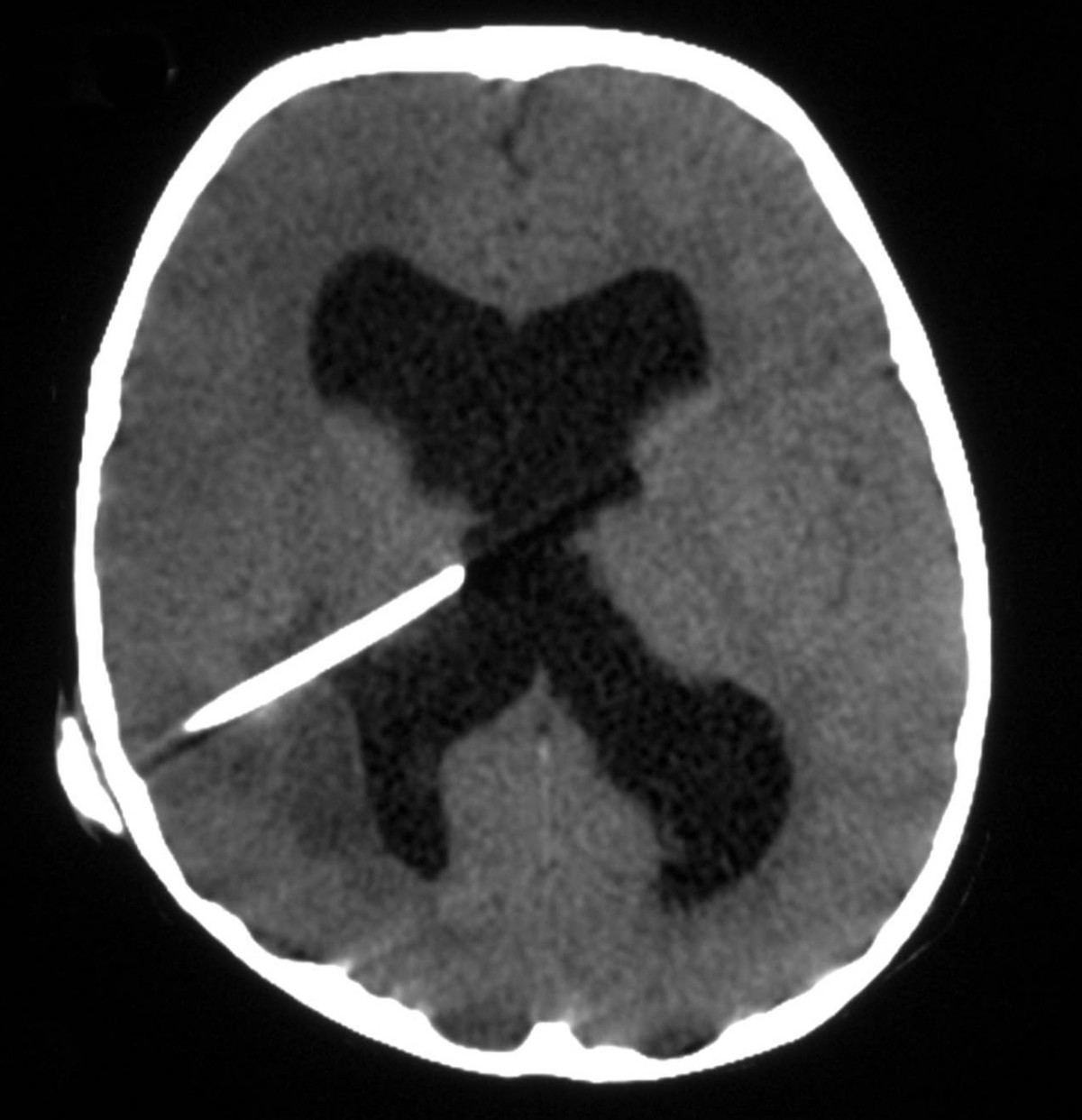 Cureus | Severe Neurocysticercosis in an Immunocompetent Male Without  Travel to an Endemic Region: A Case Report | Article