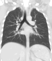 File:Coronal average intensity projection CT thorax.gif