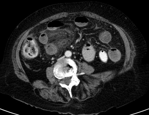 File:Galleinsteinperforation mit Duendarmnekrose - CT - axial - 030.jpg