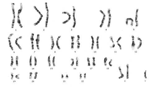 Klinefelter's Syndrome XXY DNA