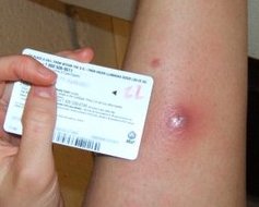 Methicillin Resistant Staphylococcus Aureus Wikiwand