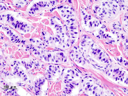 File:Pancreatic insulinoma (2).JPG