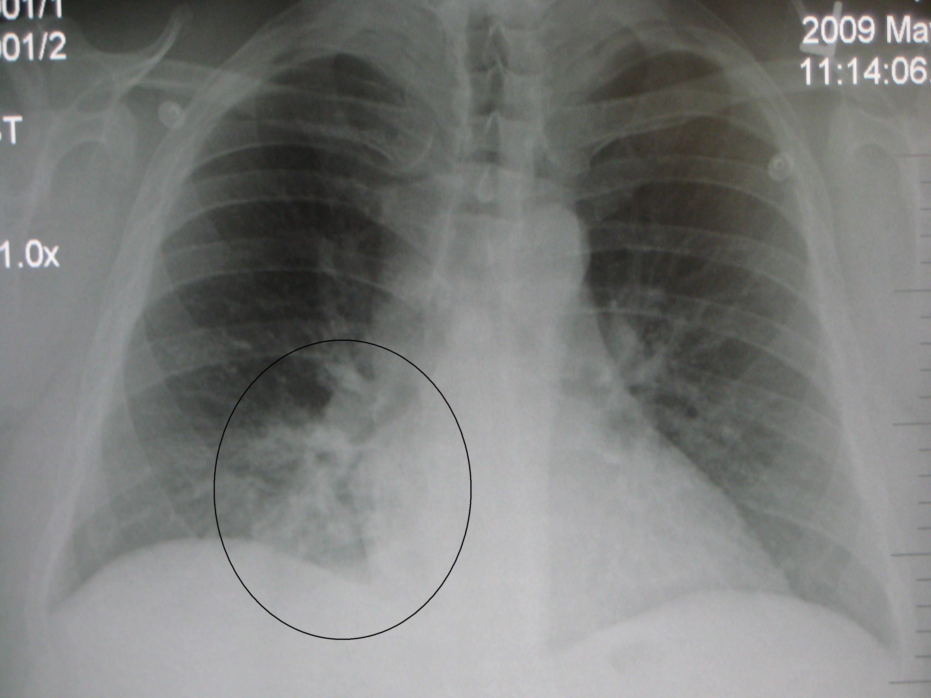 chest x ray pneumonia