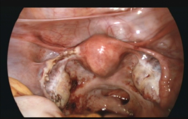 File:Salpingectomy1981.jpg