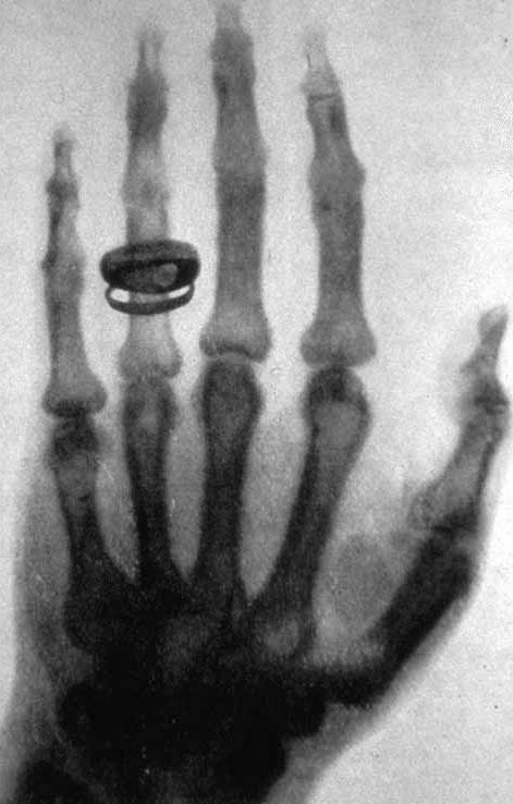 X-ray by Wilhelm Röntgen of Albert von Kölliker's hand - 18960123-02
