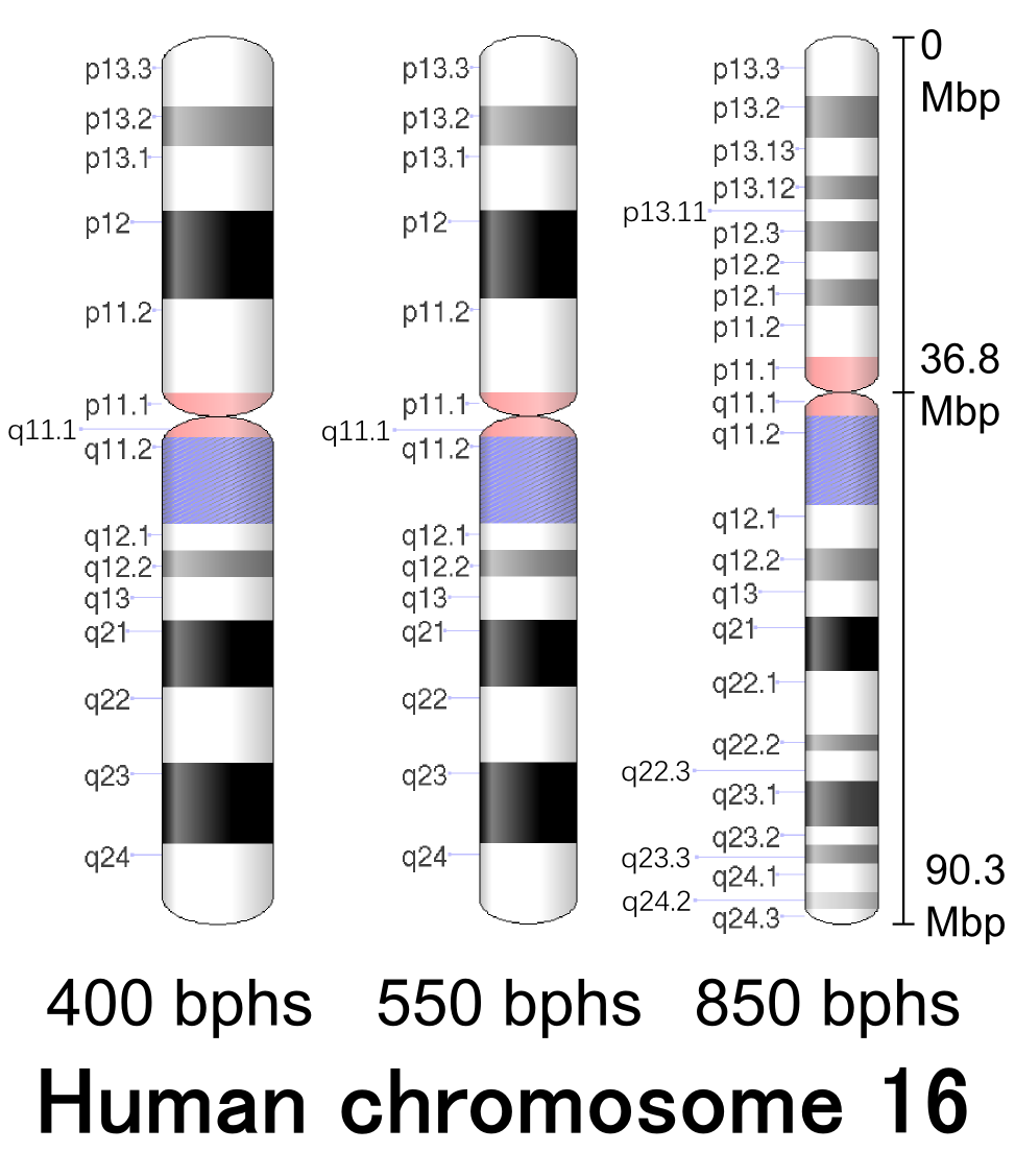 Chromosome 16p13.3 Contiguous Gene Deletion Syndrome including the SLX4,  DNASE1, TRAP1, and CREBBP Genes Presenting as a Relatively Mild Rubinstein- Taybi Syndrome Phenotype: A Case Report of a Saudi Boy. - Document 