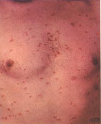 lesions on chest