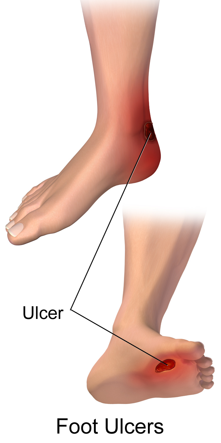 How To Spot The Signs Of A Diabetic Ulcer On The Foot: Midwest Institute  for Non-Surgical Therapy: Vascular and Interventional Radiologists