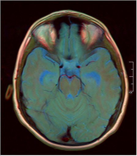 File:Brain MRI 0199 14.jpg