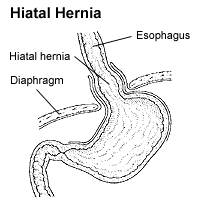 Hiátová hernie