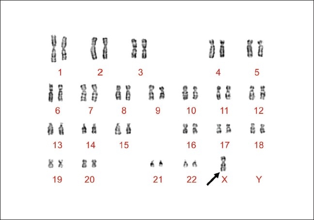 File:Karyotype of proband with Neurofibromatosis type 1, Tuberous Sclerosis complex and Turner Syndrome. The arrow indicates the presence of only one X chromosome in Karyotype.jpg