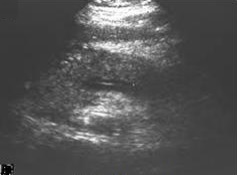 Abdominal ultrasonography of acute pancreatitis
