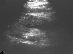 File:Ultrasonography of acute pancreatitis.jpg