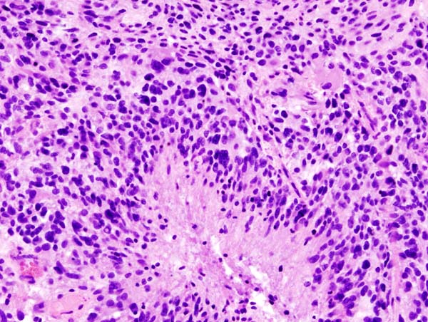 File:Glioblastoma (1).jpg