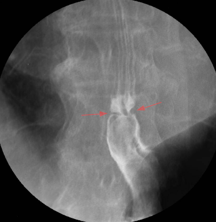 PDF] Esophageal Rings and Stricture Related to a Circumferential Inlet  Patch | Semantic Scholar