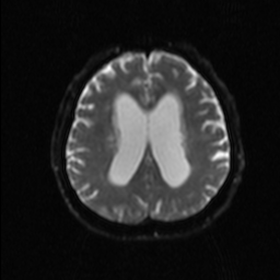 File:NPH MRI 148.png