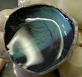 Calf-Eye-Posterior-With-Retina-Puckering-2005-Oct-13.jpg