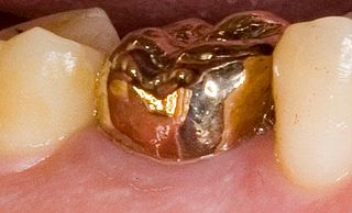 <span class="mw-page-title-main">Gold teeth</span> Form of dental prosthesis