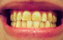 שיניים של אדם חורק שיניים. ניתן לראות פגיעה בשיניים הקדמיות כתוצאה ממגע מוגבר ביניהן