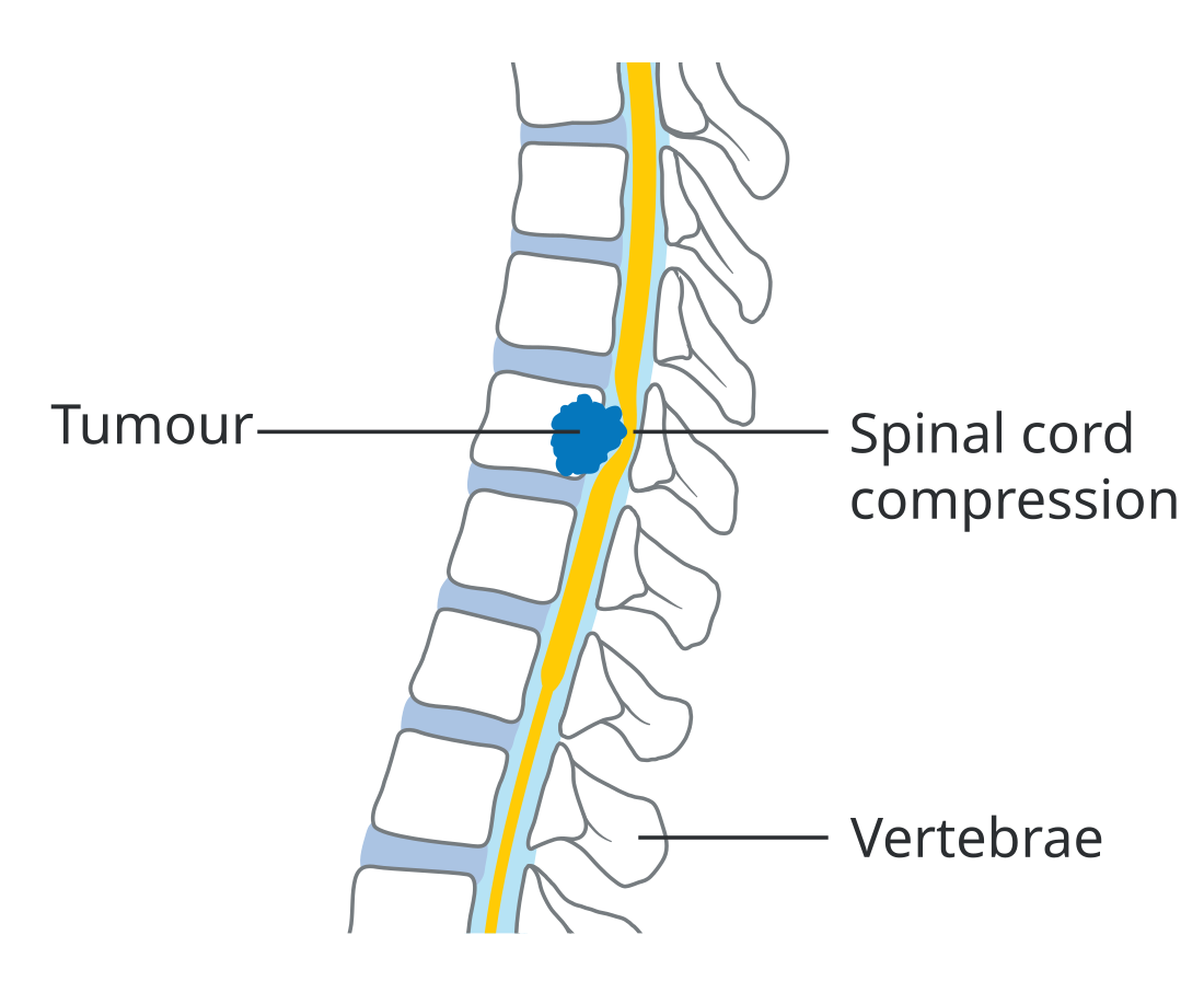 Spinal cord compression