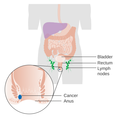 File:Diagram showing stage 1 anal cancer CRUK 189.svg