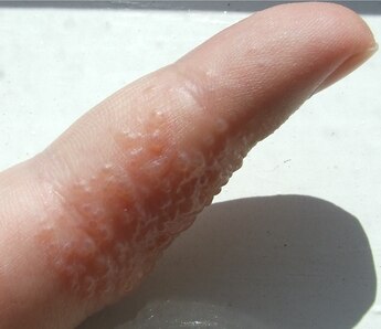 clear blisters on hands