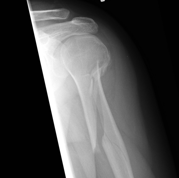 File:Humerus spiral fracture.png