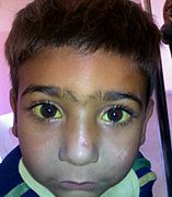 Un bambino di 4 anni con sclera itterica (giallastra) dovuta ad anemia emolitica.