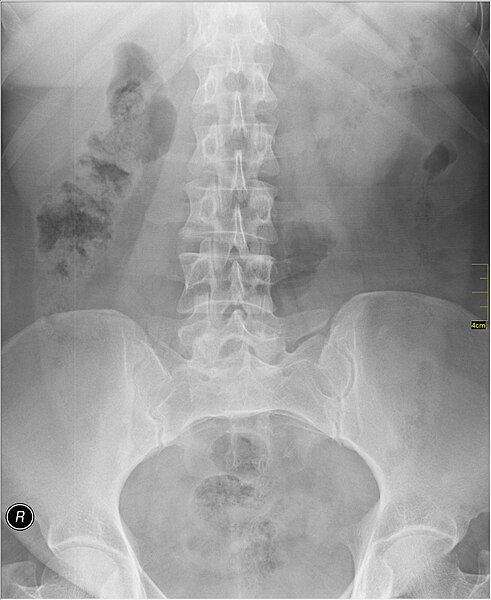 File:Medical X-Ray imaging QIJ06 nevit.jpg