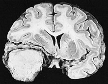 Cross section of a meningioma displacing the underlying brain. Meningioma.jpg