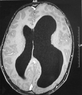 <span class="mw-page-title-main">Hemimegalencephaly</span> Disorder affecting development of one side of the brain