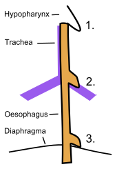 The 3 classifications of esophageal diverticula. 1-Pharyngeal (Zenker's) 2-Midesophageal 3-Epiphrenic Oesophageal diverticula.svg