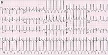 JET in a 2-month-old girl following cardiac surgery. In this case the right bundle branch block was present during tachycardia and during normal sinus rhythm. PMC6092634 Valdes 2018 JET ECG.jpg