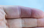 Thumbnail for File:Paroxysmal hand hematoma Achenbach syndrome doigt bleu 02.jpg