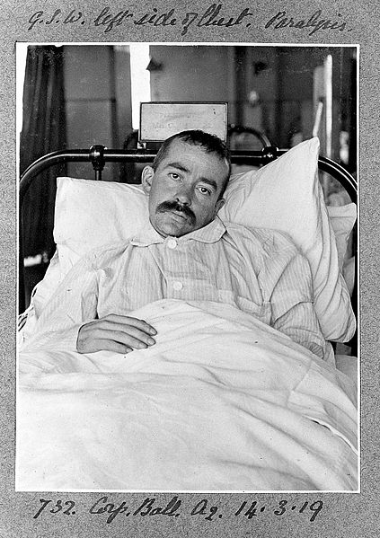 File:Patient paralysed by gunshot wound. Wellcome L0025837.jpg