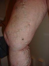tablete în vene varicoase pe picioare recuperare varicoza