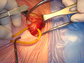 Inguinal hernia surgery Medical procedure