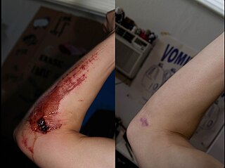 <span class="mw-page-title-main">Road rash</span> Medical condition