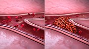 Thumbnail for Sickle cell nephropathy